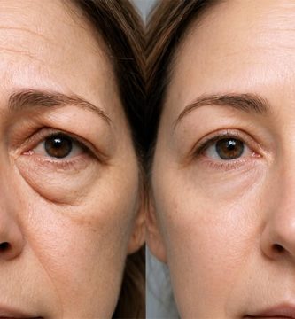 blefaroplastia-cirugia-de-parpados
