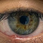chalazion-oftalmologia