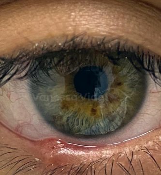 chalazion-oftalmologia