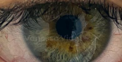 chalazion-oftalmologia