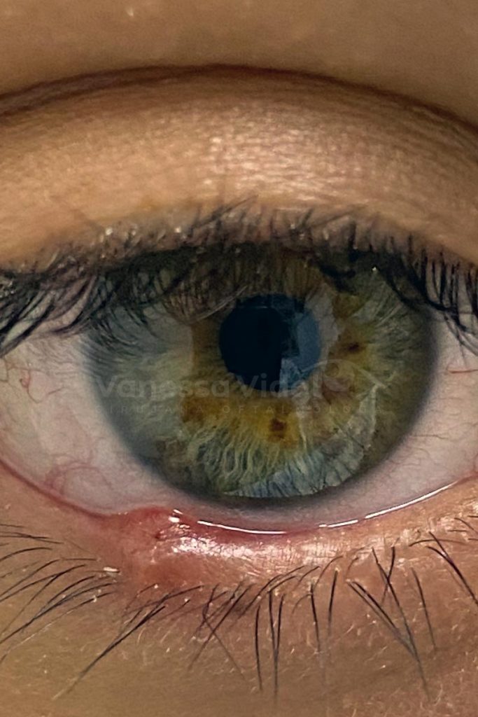 chalazion-oftalmologia